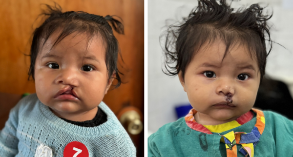 Girl before and after cleft repair surgery