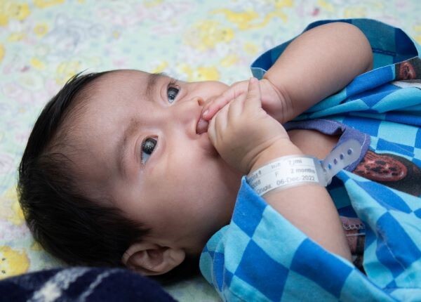 Baby with cleft lip wearing blue and lying in hospital