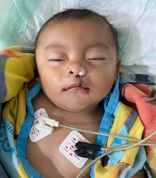 Baby boy after cleft lip repair surgery