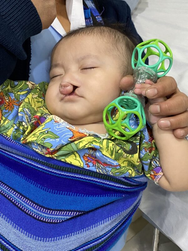 Baby with cleft lip holding a rattle
